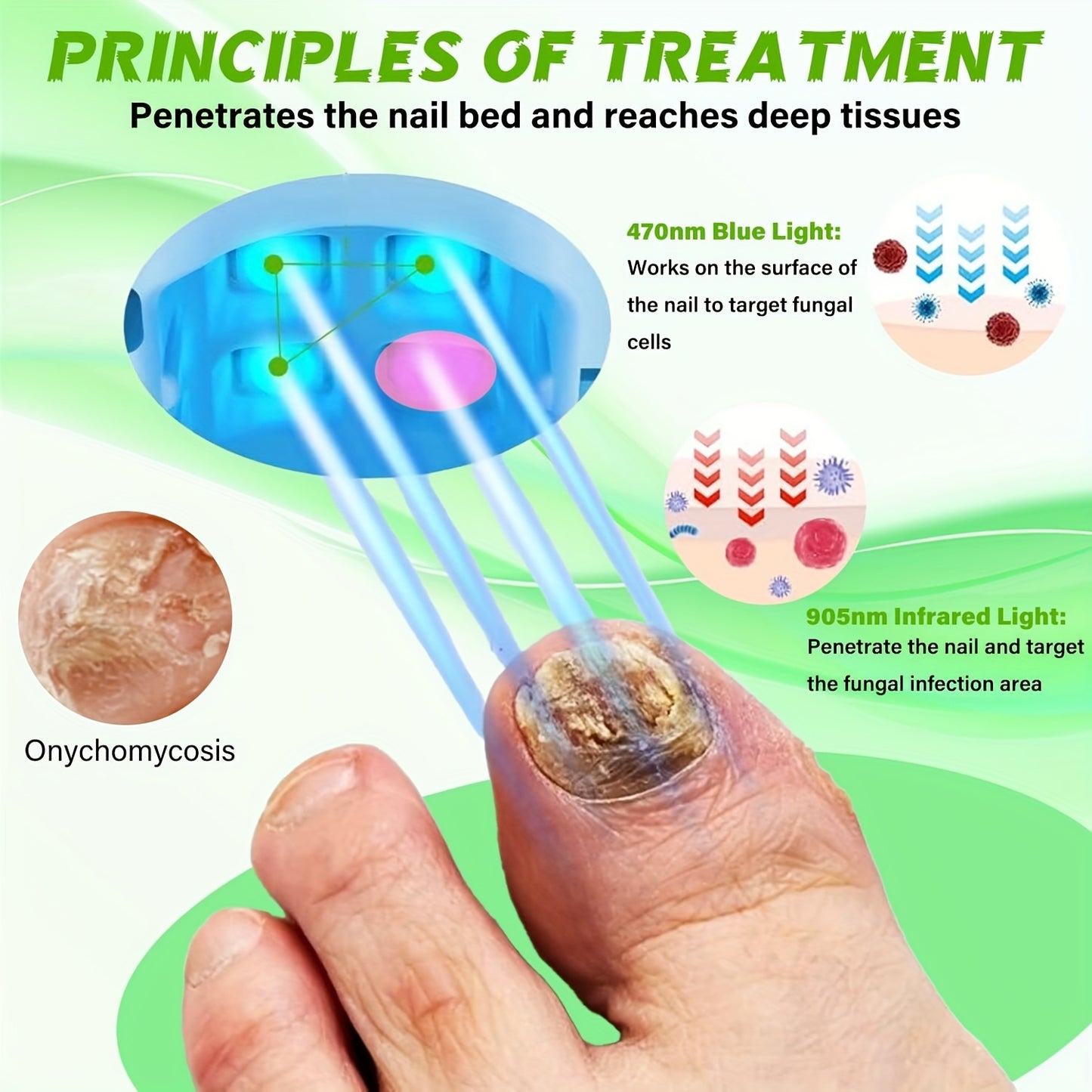🦶Fungal infection laser treatment device
