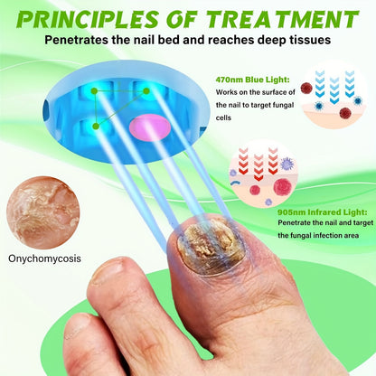 🦶Fungal infection laser treatment device